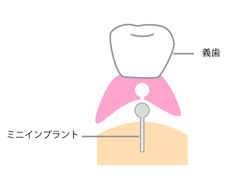 ミニインプラントと義歯