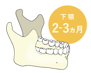 下あごは3ヵ月前後で骨と結合します