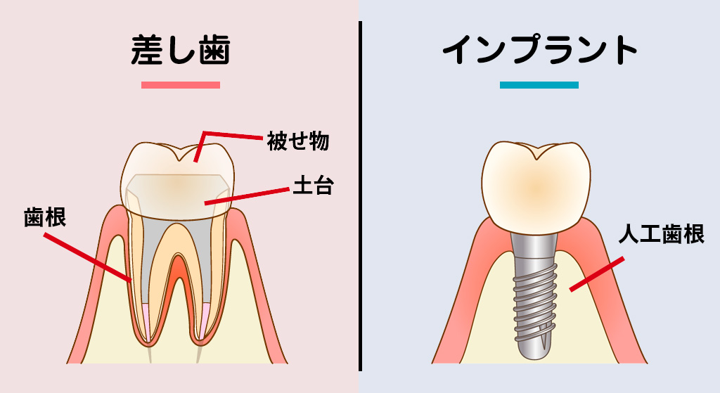 差し歯 と インプラント の 違い
