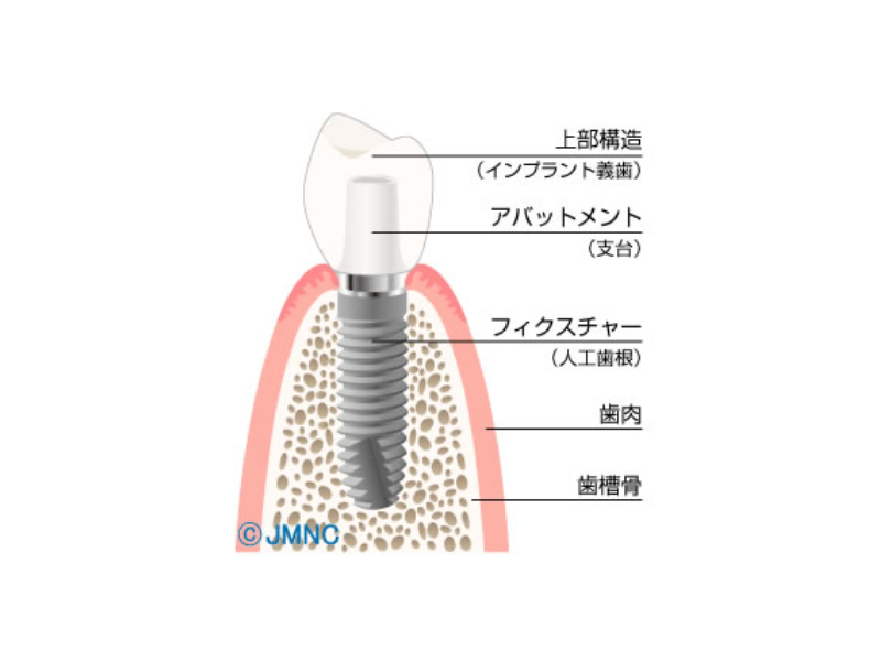 インプラントのネジが見えるのはどんな状態?