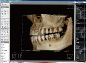 歯科用CT