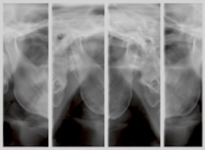 顎関節パノラマレントゲン