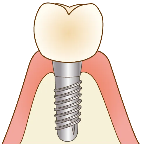 奥歯にはインプラント治療がおすすめ！