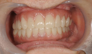 義歯による嘔吐反射を改善したオールオン4治療