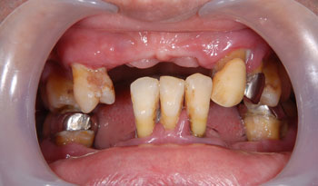 歯科恐怖症の方のオールオン4治療