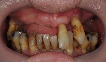 オールオン4による歯周病治療