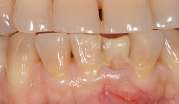 下顎の前歯のインプラント治療
