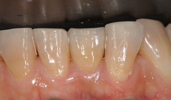 下顎の前歯のインプラント治療