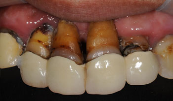 重度の歯周病患者様の歯周病治療と前歯のインプラント