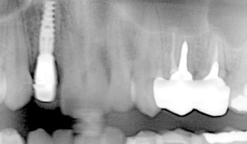 事故で前歯を失われた方の審美・機能回症例