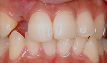 事故で前歯を失われた方の審美・機能回症例
