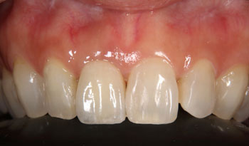 前歯の歯根破折で抜歯になられた方のインプラント治療