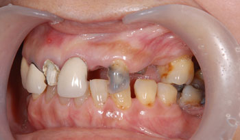 インプラントと補綴による全体的な虫歯治療
