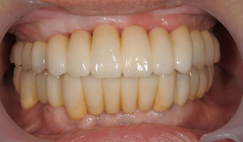 全ての歯をインプラントにより並べたフルマウス治療