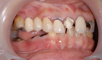 インプラントと補綴による全体的な虫歯治療