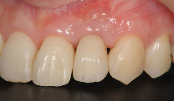 骨造成と歯肉移植を併用したインプラント治療