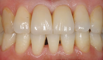 歯根破折によって抜歯した前歯のインプラント治療