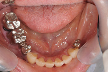 奥歯のインプラント症例