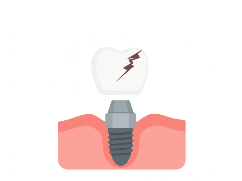 上部構造（かぶせ物）の破損