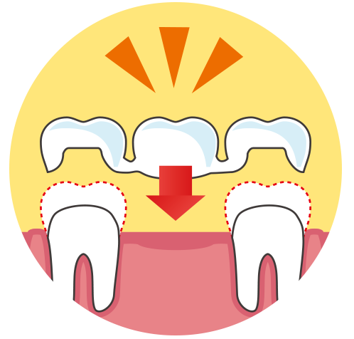 歯を削りブリッジを被せる