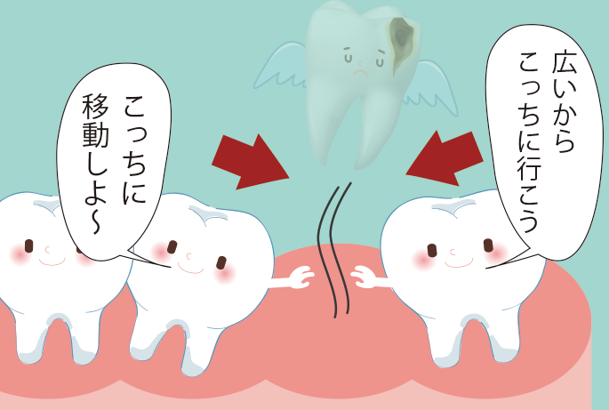 歯がないスペースへ向かって傾く