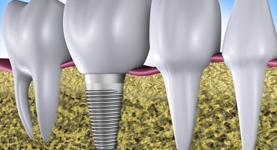 インプラントと歯根