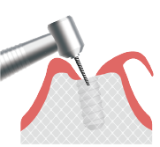 インプラント一次手術の流れ②