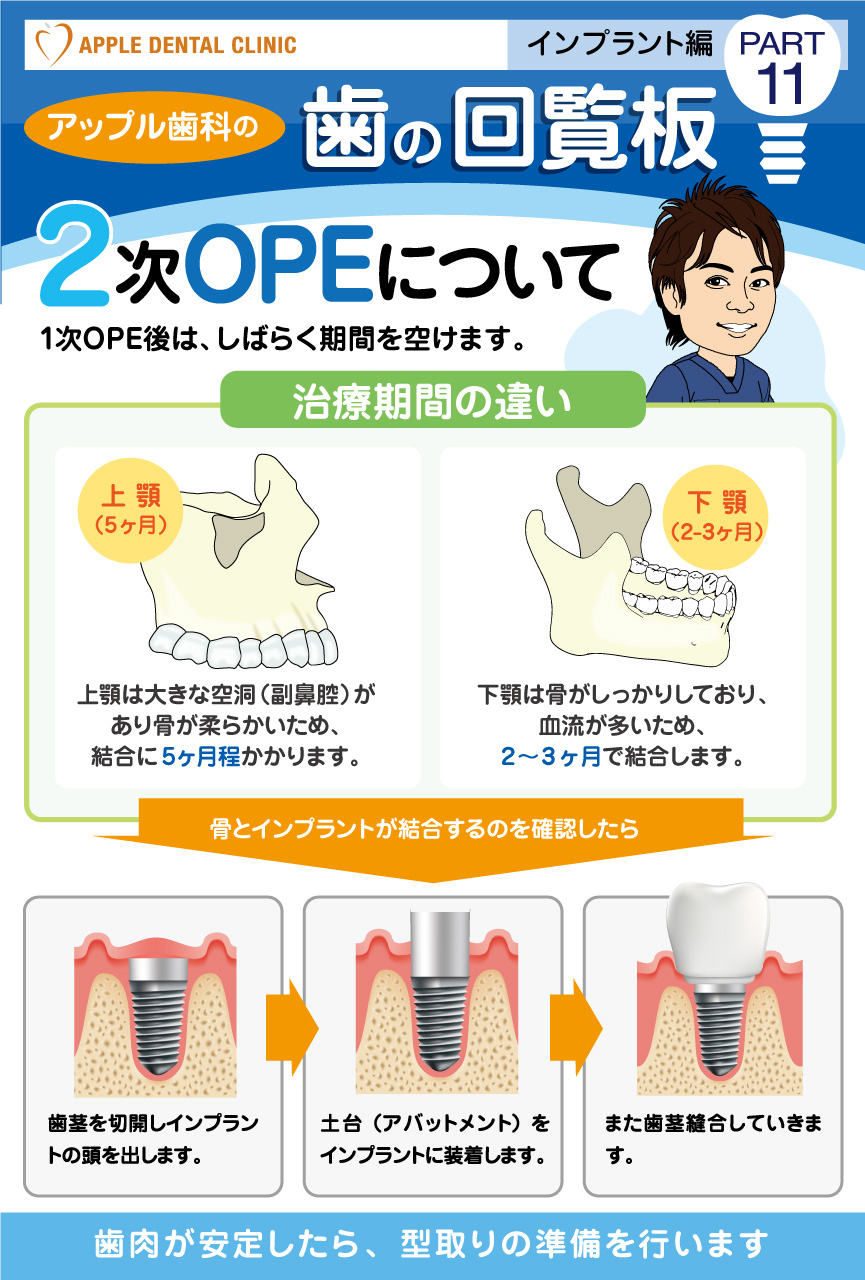 歯の回覧板インプラント編