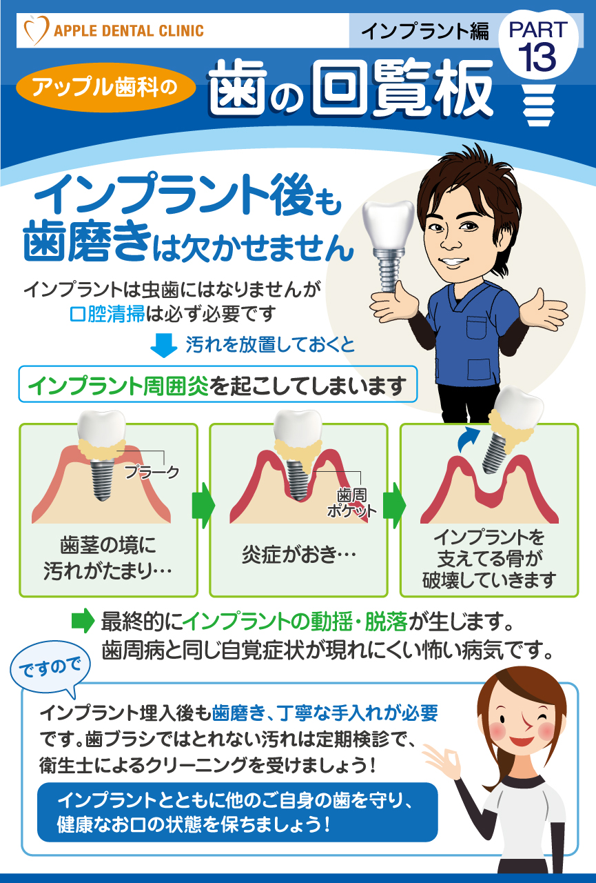 歯の回覧板インプラント編