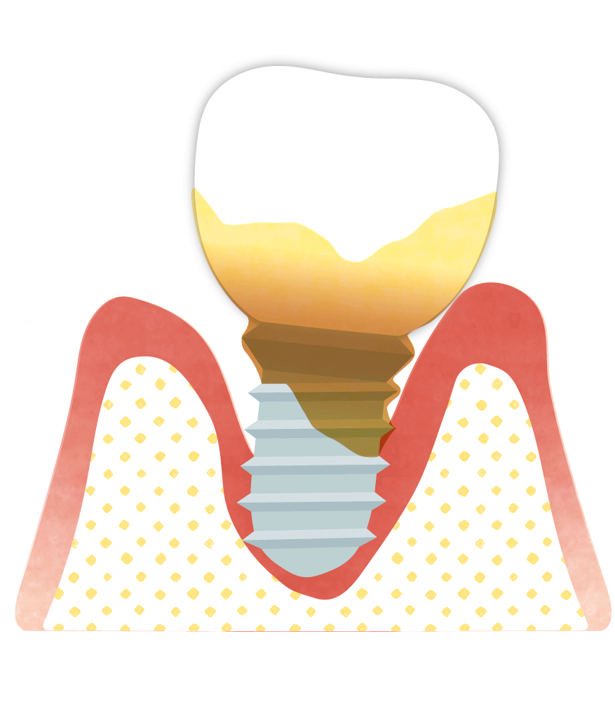 インプラント周囲炎の発症