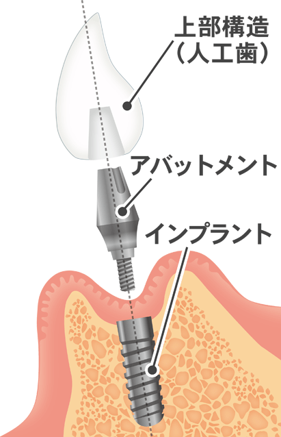 インプラント上部構造の素材が見た目を左右する