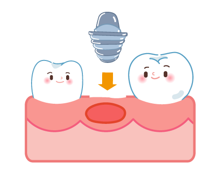 抜歯即時埋入