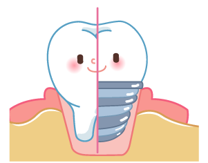 歯をインプラントにしたイメージ