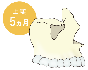 上あごは5ヵ月前後かかります