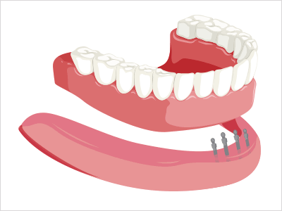 図：入れ歯を小さなインプラントで固定