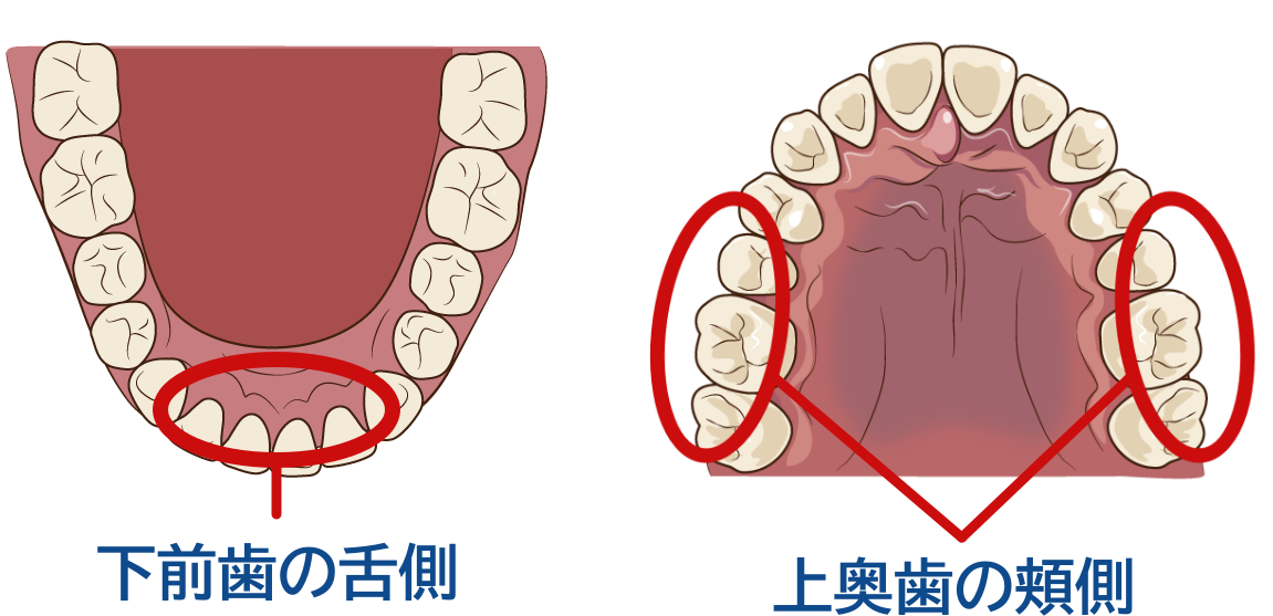 プラークをそのまま放置してしまうと…