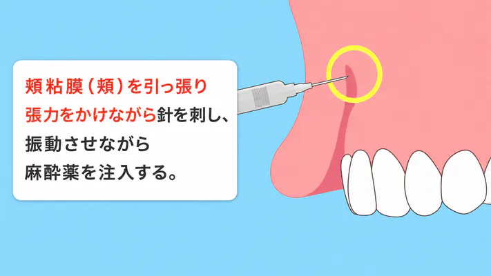 麻酔の注入方法の解説イラスト